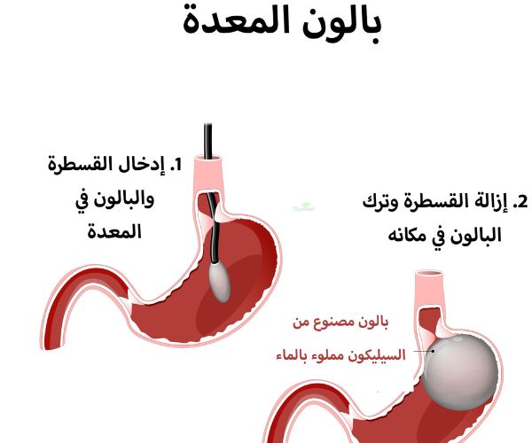 بالون المعدة